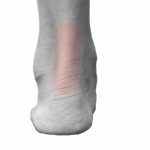 Achilles Heel in triathlon running Achilles Heel in triathlon running