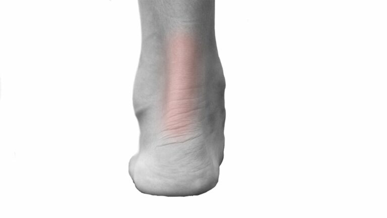 Achilles Heel in triathlon running